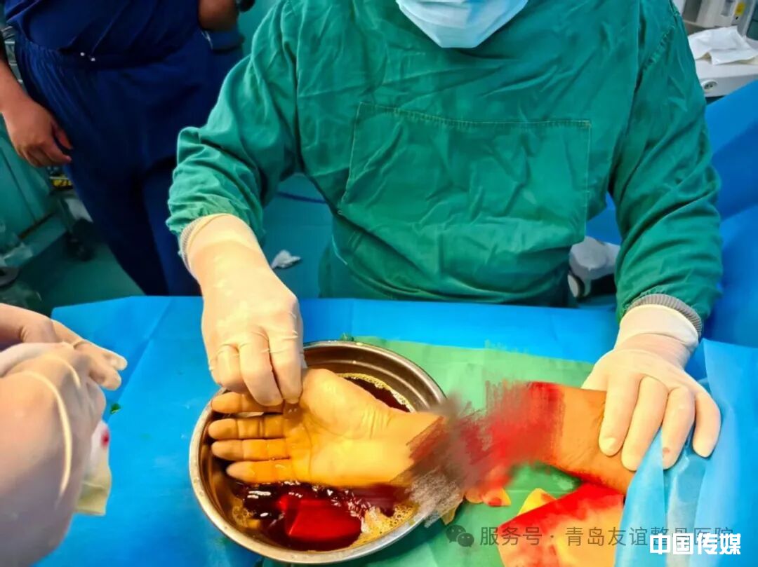 高难度右腕离断再植，紧急接诊！青岛友谊整骨医院成功完成高难度右腕离断再植手术